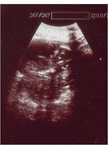 Ultrasonografía del bebe de Rene Pleitez